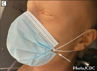 Surgical mask with earloops tied for a better fit